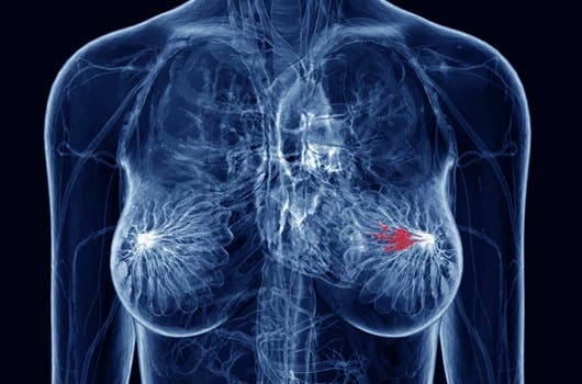 El efecto de la obesidad en los tejidos favorece el cáncer de mama