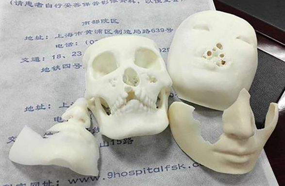 Mujer recuperará nariz y boca gracias a operación con impresión 3D