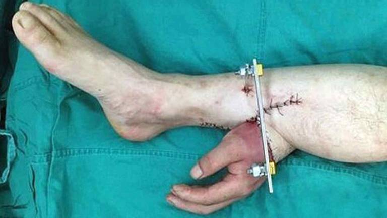Cirujanos chinos injertan la mano de un hombre a su pierna