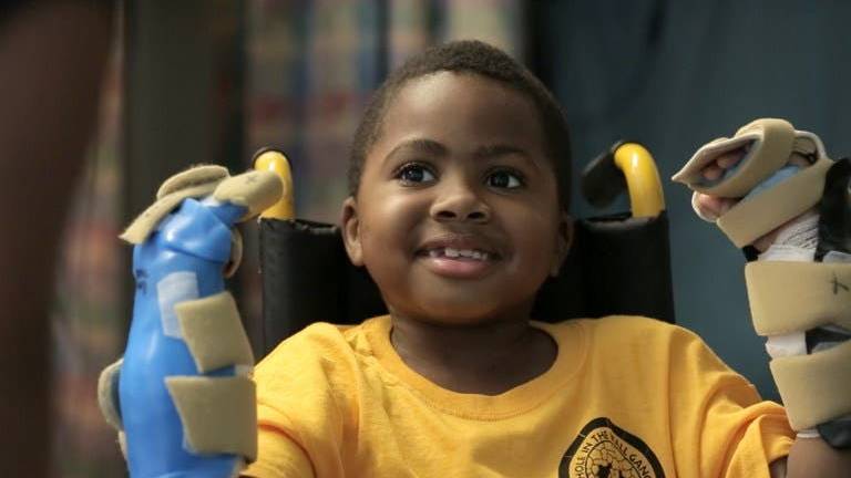 El primer trasplante doble de manos realizado a un niño