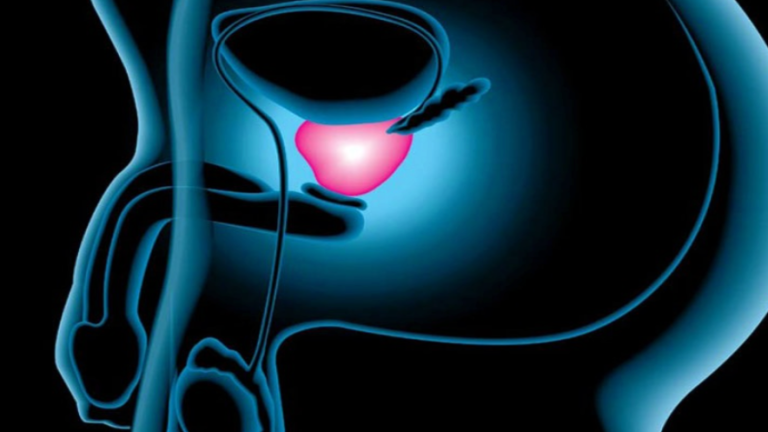 Vigilar el cáncer de próstata, tan efectivo como la radioterapia