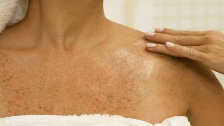 Una forma de vitamina B3 reduce el riesgo de cáncer de piel