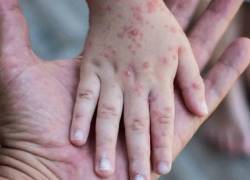 Se activa comité de control en Ecuador por brote de sarampión