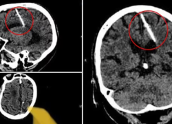 Capturas de las tomografías que revelaron la posición de la aguja.