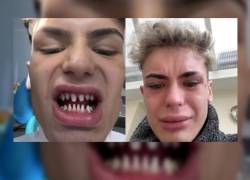 Jack James terminó devastado tras ver cómo quedaron sus dientes tras un diseño de sonrisa con carillas.