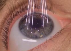 Si estás considerando la cirugía ocular para no tener que usar anteojos o lentes de contacto, estas indicaciones recomendadas por especialistas son fundamentales al momento de decidirte.