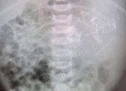 Una vez que la bebé nació y se la sometió a rayos X y ahí se descubrió el fenómeno.