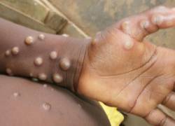 La viruela de Mono no es una enfermedad muy común, según los CDC.