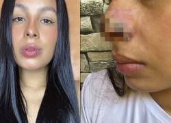 Mujer casi pierde la nariz luego de un tratamiento con ácido hialurónico