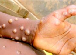 OMS advierte sobre rara enfermedad denominada viruela del mono, detectada en varios países