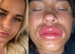 Sufrió deformidad por beber alcohol luego de un aumento de labios