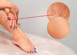 Cuida tus piernas de las varices con una correcta alimentación.