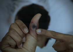 Fotografía que muestra las marcas que causa en el cuerpo la mpox.