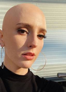 Mujer con alopecia se rapó y conmovió a todos con su belleza