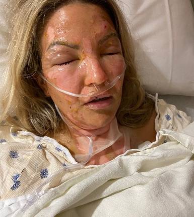 Mujer sufre graves quemaduras tras encender una vela después de haberse aplicado desinfectante en las manos