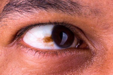 Cáncer de ojo: ¿Cuáles son los síntomas y cómo detectarlo a tiempo?