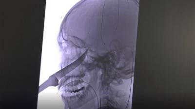 Adolescente sobrevive tras clavarse un cuchillo de 25 cm en el rostro