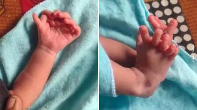 Extra&ntilde;o nacimiento de una beb&eacute; con 26 dedos en manos y pies: su familia considera que es la reencarnaci&oacute;n de una diosa