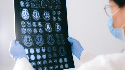 Estudios vinculan el covid prolongado con síntomas tempranos de Alzheimer Estudios vinculan el covid prolongado con síntomas tempranos de Alzheimer