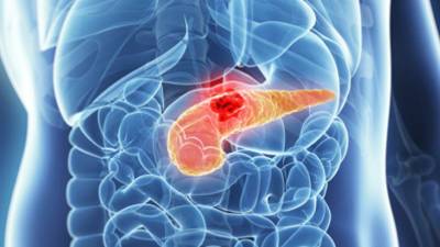 Identifican proteína clave en desarrollo de cáncer de páncreas Identifican proteína clave en desarrollo de cáncer de páncreas