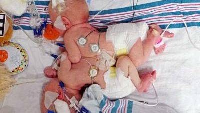 Separan a siameses de 5 meses unidos por el abdomen en Estados Unidos