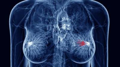 Medicamento reduce 30 % el riesgo de muerte por cáncer de mama Medicamento reduce 30 % el riesgo de muerte por cáncer de mama