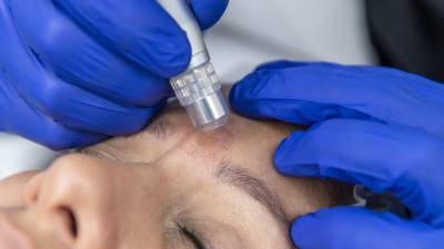 Vence las arrugas con la sublimaci&oacute;n de plasma