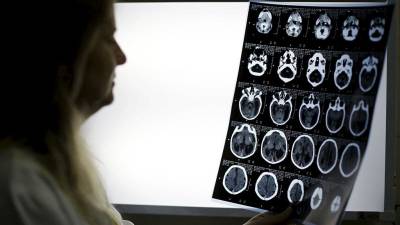 El zika daña las células que forman la corteza cerebral El zika daña las células que forman la corteza cerebral