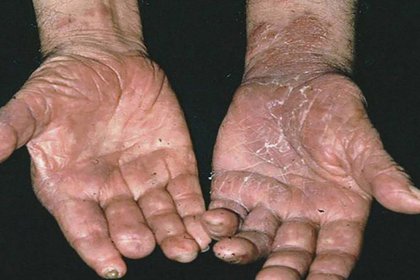 Alerta por casi 90 casos de lepra en México