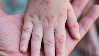 Ascienden a 16 los contagios con viruela del mono en Ecuador: hay ni&ntilde;os diagnosticados 