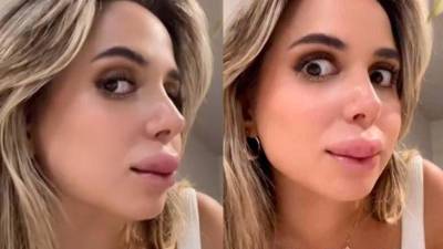 Se hizo un aumento de labios y el resultado la volvió viral Se hizo un aumento de labios y el resultado la volvió viral