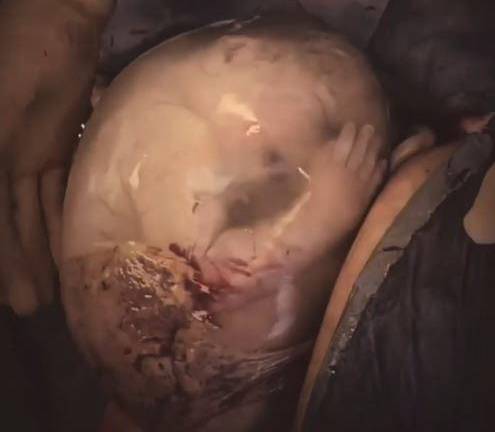 Extraordinario video un bebé nacido con su bolsa amniótica intacta