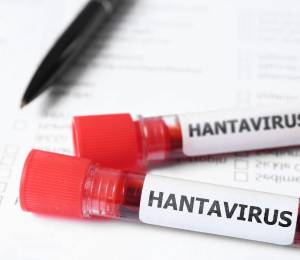 Imagen de muestras de sangre infectadas con hantavirus. En Venezuela ya hay tres casos de personas fallecidas por este virus.