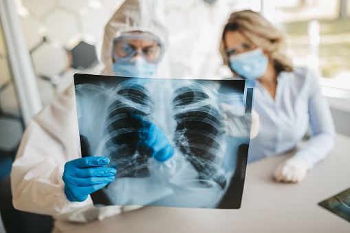 La COVID-19 podría causar anomalías pulmonares hasta 3 meses después de contagio