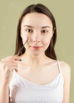 Joven con acné. Expertos han demostrado que el acné y la microbioma de la piel tienen relación.