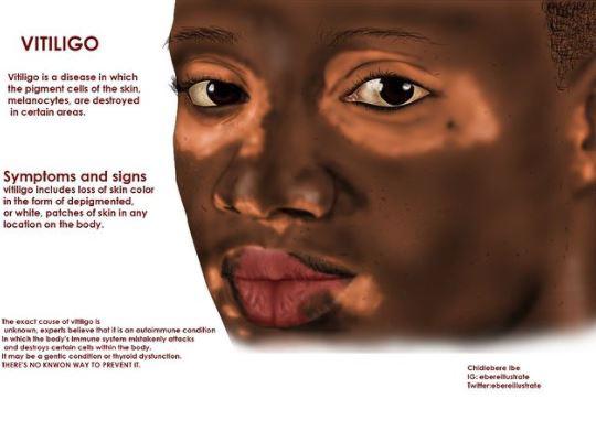 $!Ilustración que detalla los efectos de la condición Vitiligo en un hombre afroamericano. Foto: Cuenta de Instagram de Chidiebere Ibe (@ebereillustrate)