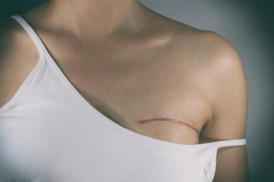 Casi el 30 % de las mujeres que padecieron cáncer de mama en Ecuador fallecieron en 2020