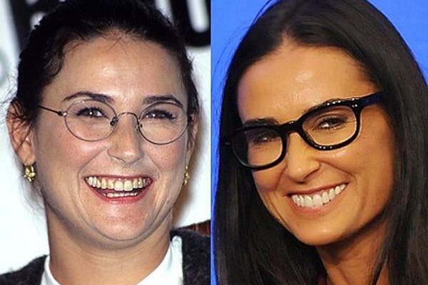 El antes y después de celebridades que retocaron su dentadura