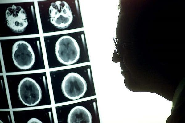 Científicos descubren una nueva vía para tratar los tumores cerebrales más agresivos