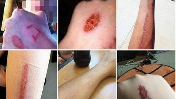 El "desafío del borrador" que deja graves quemaduras