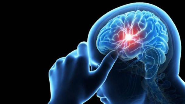 $!De acuerdo datos de Cleveland Clinic, un portal médico de Estados Unidos, aproximadamente el 25% de personas que experimentan un aneurisma cerebral fallecen dentro de 24 horas.