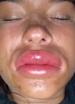 Sufrió deformidad por beber alcohol luego de un aumento de labios