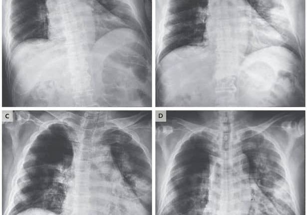 Autopsias revelan que el COVID-19 ya estaba matando en EEUU antes desde febrero