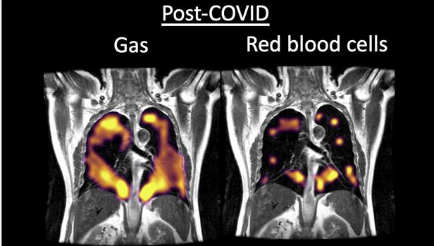 Esto es lo que provoca el COVID-19 en los pulmones