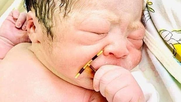 Bebé nace sosteniendo una &quot;T de cobre&quot; que su madre tenía en el útero.