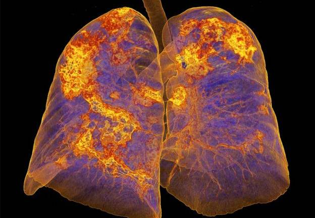 ¿Cómo afecta el coronavirus a nuestro organismo?