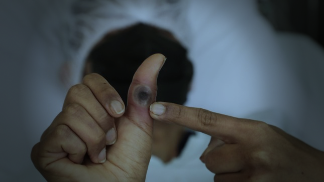 Primer caso de la variante clado Ib de la mpox se detecta en Ecuador