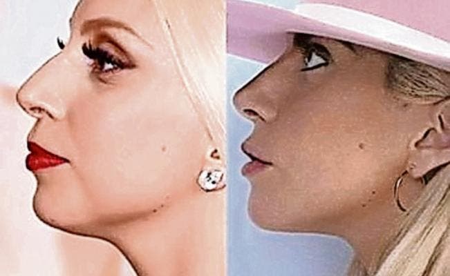 Gaga acusada de traicionar a sus fans con su cirugía estética