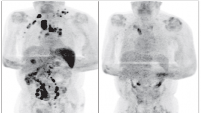 Milagroso resultado de la COVID-19 en paciente que se curó de linfoma de Hodgkin podría ser clave para el cáncer