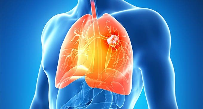 Cáncer de pulmón: la clave para la detección temprana está en la nariz